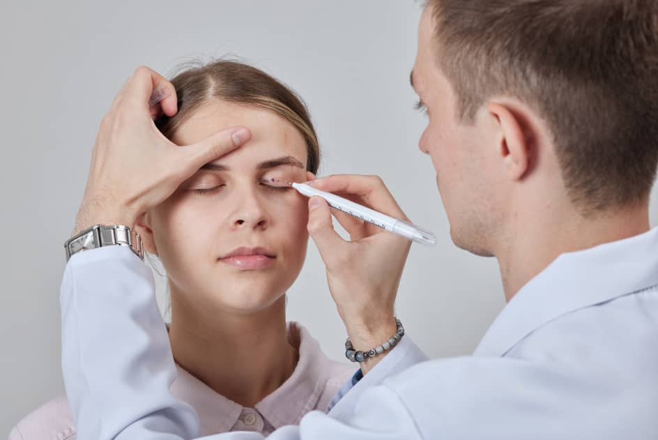 Blépharoplastie - marquage préopératoire