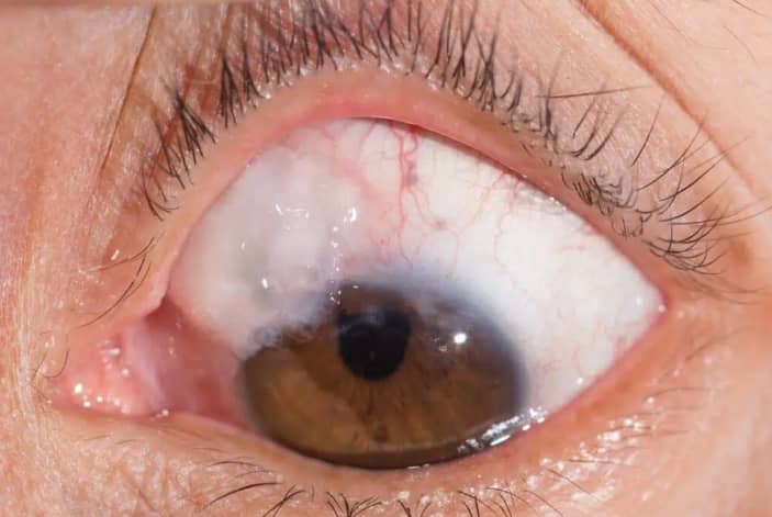 Chirurgie glaucome