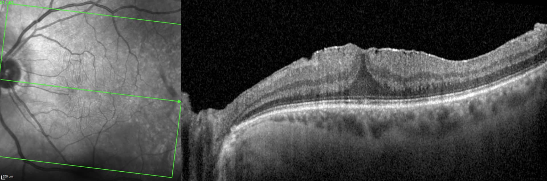 Membrane épirétinienne - OCT