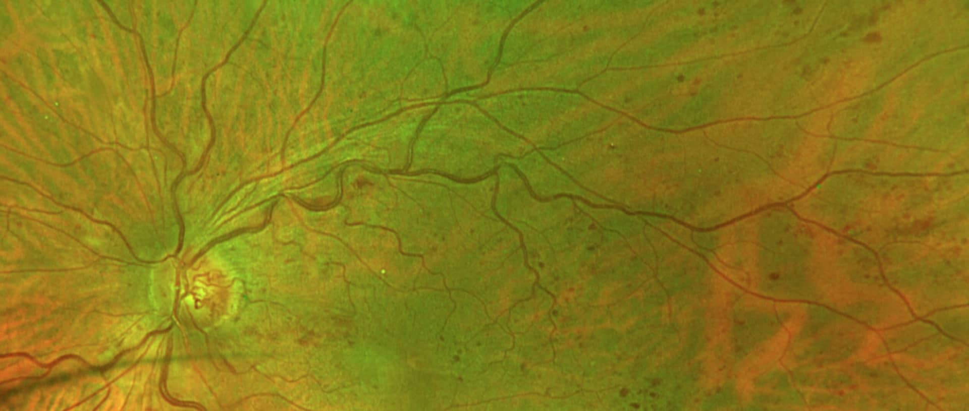 Occlusion veineuse rétinienne - fond d'œil