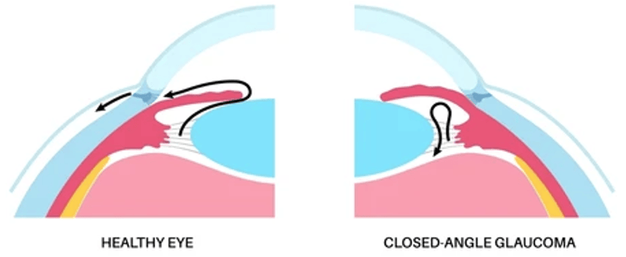 Glaucome à angle ouvert
