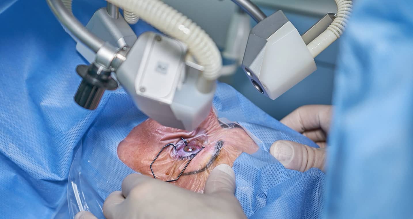 Chirurgie réfractive au laser