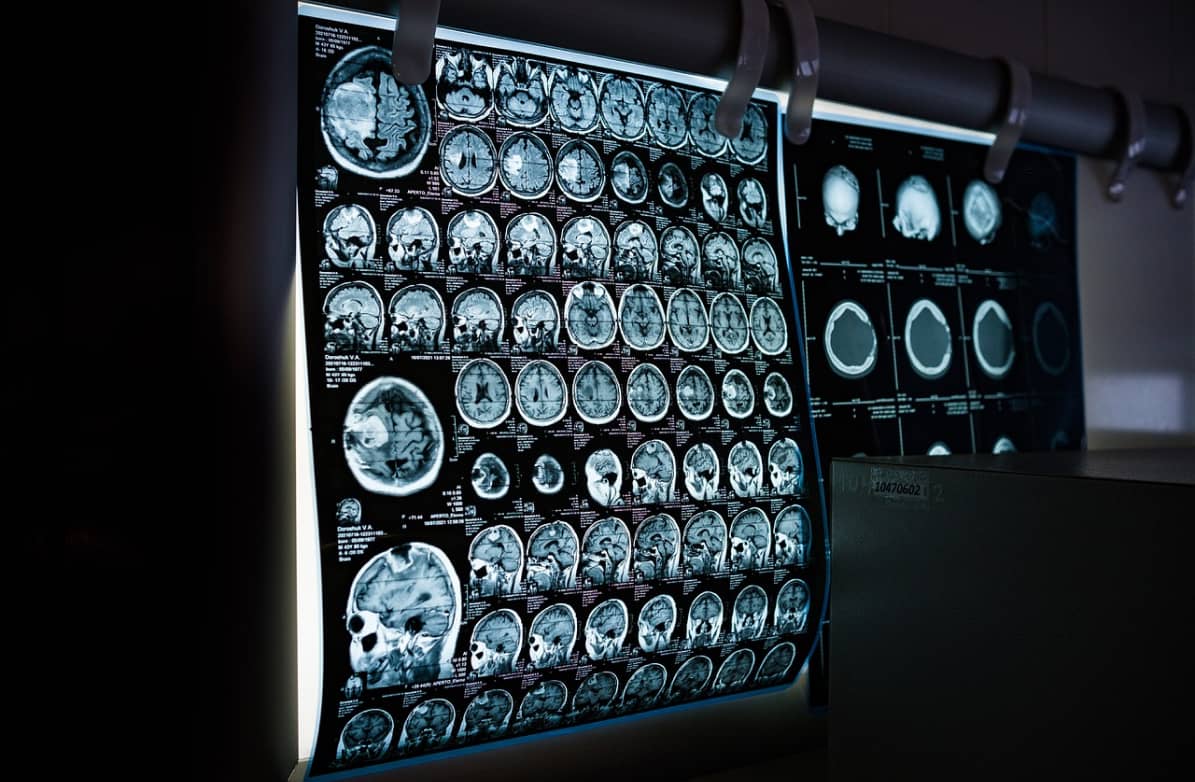 Neuro-ophtalmologie